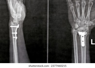 X-ray of a skeletal human hand with metallic implants, suggesting unsettling medical experimentation.